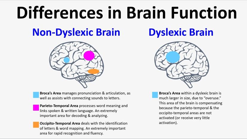 Differences in Brain Function: Non-Dyslexic Brain vs Dyslexic Brain